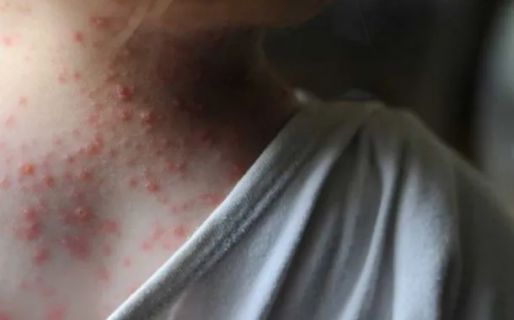 Preocupación por la aparición de casos de la viruela del mono: 12 países detectaron 80 contagios