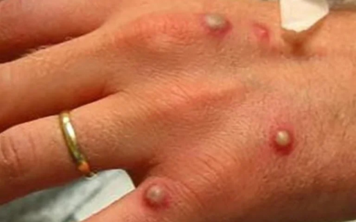 Reportaron ocho casos de viruela del mono, uno de ellos en la Patagonia