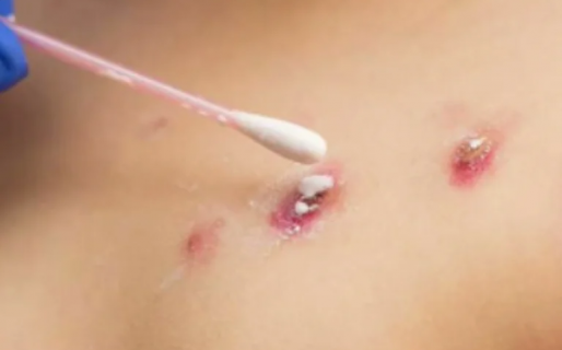 Confirman un caso positivo de Viruela del mono en Santa Cruz