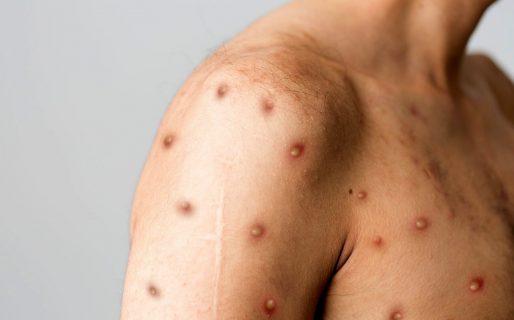 Viruela del mono: la OMS emitió un pedido a todos los países para contener el brote mundial