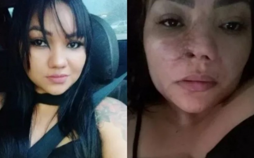 Se operó la nariz y quedó desfigurada: se enteró que fue intervenida por un dentista