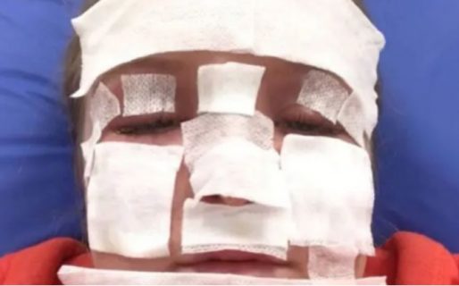 Increíble: así quedó una influencer después de broncearse en una cama solar rota