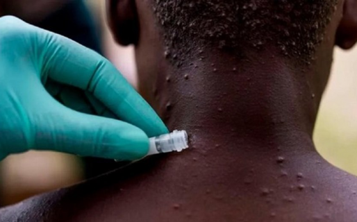 Estudio revela que 95% de casos de viruela del mono se transmite por actividad sexual