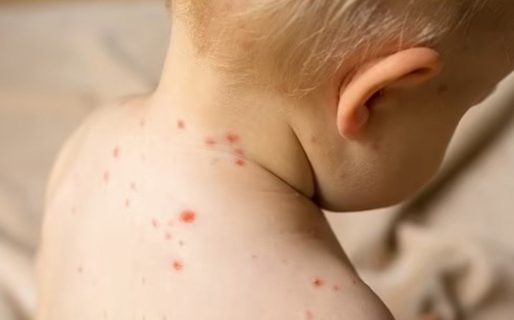 Advertencia por la «gripe del tomate»: nueva enfermedad afecta a niños menores de 5 años