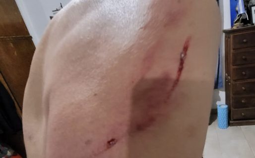 Denuncia que un perro callejero lo atacó cuando caminaba por avenida Kennedy