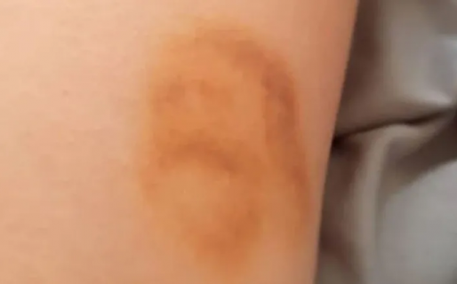 Se golpeó y le salió un moretón con la cara de Jesús