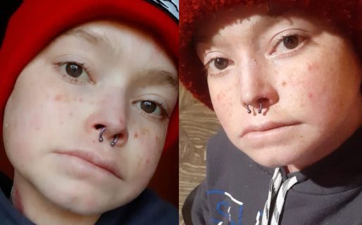 Por una extraña enfermedad en la piel, está perdiendo las manos y necesita ayuda: “No puedo ni comer”