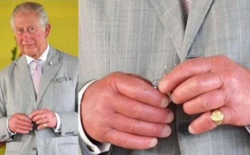 Las posibles explicaciones de ‘los dedos de salchicha’ del rey Carlos III