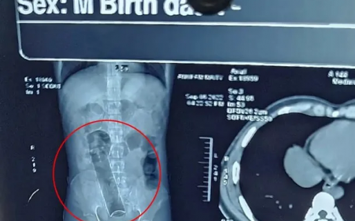 Un joven estuvo tres semanas con un desodorante enterrado en el ano