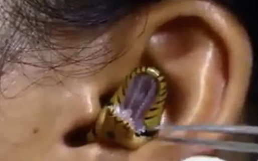 Horror: una serpiente se metió en la oreja de una mujer y debieron operarla