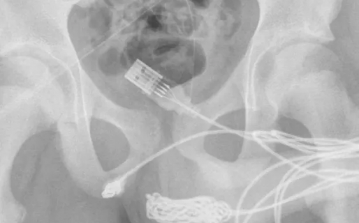 Se le trabó un cable USB en el miembro y tuvieron que operarlo