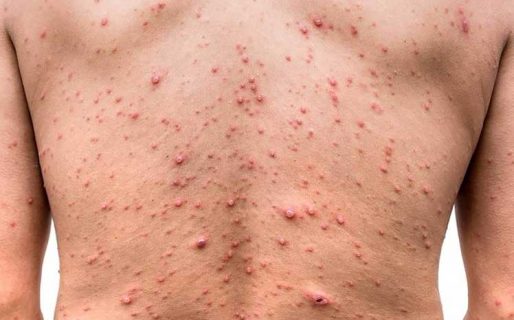 Se registró el primer caso de viruela del mono en Comodoro