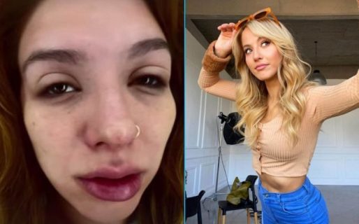 Flor Vigna tuvo una reacción alérgica y mostró cómo se le hinchó la cara