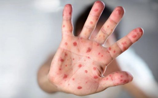 Viruela del mono: ya hay 22 casos confirmados en Argentina