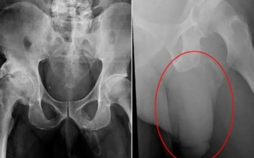 Se dio cuenta de que su miembro estaba transformándose en hueso y un estudio lo terminó confirmando