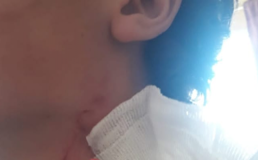 Un padre salvó la vida de su hijo matando a un pitbull que lo mordió en el cuello