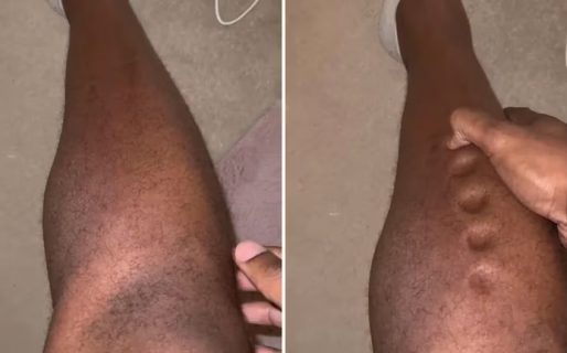 “Piel de plastilina”: La patología que sufre un atleta olímpico y recorre las redes