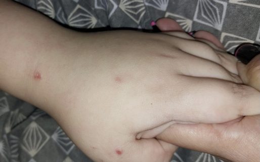 Niños de la Escuela 23 de Palazzo resultaron con picaduras y reacciones alérgicas