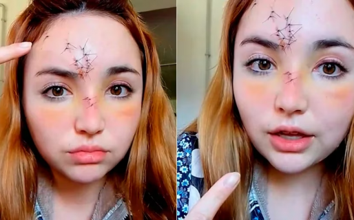 Fue a bailar a un boliche, recibió un botellazo y terminó con 14 puntos en la frente