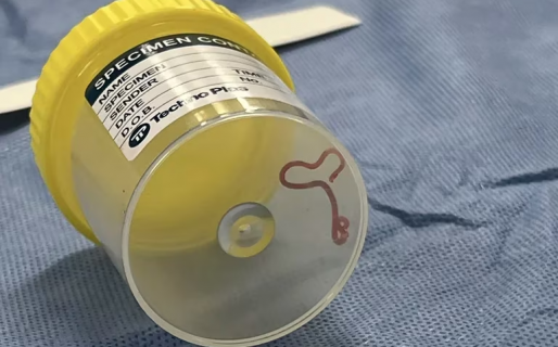 Tras meses sufriendo olvidos y depresión, descubrió que tenía un gusano vivo en el cerebro