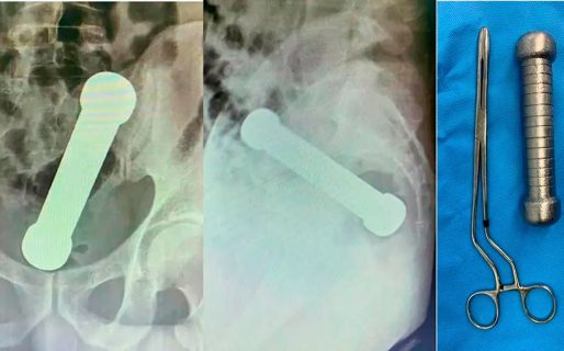 La historia del hombre que internaron tras un peligroso juego sexual: lo operaron para extraerle una mancuerna