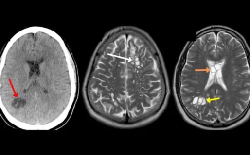 Fue al médico porque le dolía la cabeza y le encontraron un gusano