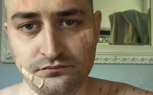 Cómo quedó el cuerpo de un hombre después de tomar 21 litros de sidra por día durante 10 años