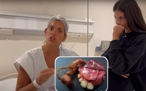 Qué es un teratoma, el tumor con pelos y dientes que le extirparon a Belu Lucius