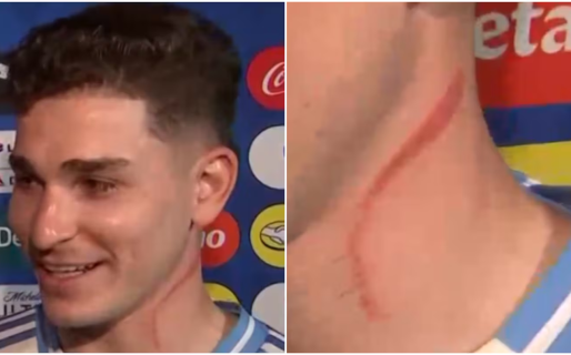 Copa América: Julián Álvarez explicó qué le provocó la impactante marca en el cuello