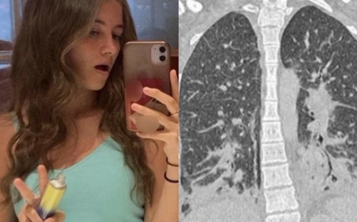 Usó un vaper durante un mes y así le quedaron los pulmones