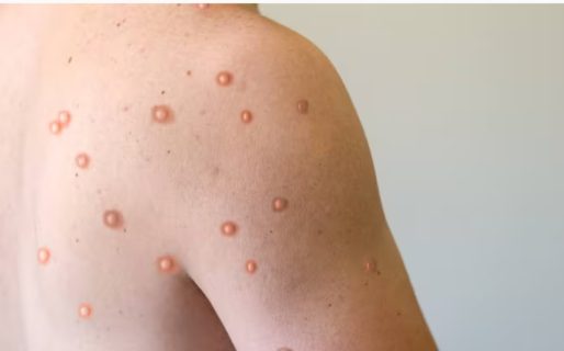 Confirman el primer caso autóctono de viruela del mono en la Argentina