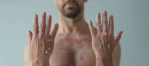 Lo que hay que saber sobre la viruela del mono después de que la OMS la declarara emergencia sanitaria mundial