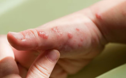 Los siete síntomas para detectar la viruela del mono y cómo evitar posibles contagios