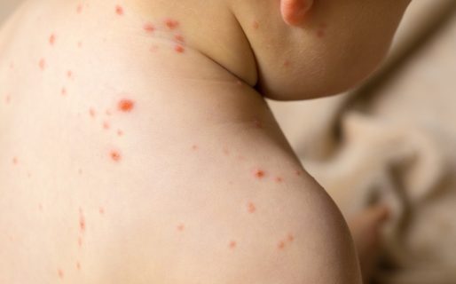 Alerta epidemiológica ante la confirmación de un caso de sarampión