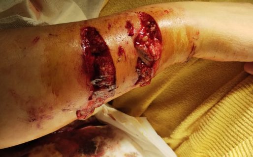 Comodoro: La atacó un perro y ahora debe pagar una cirugía millonaria