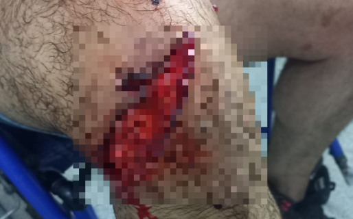 «Me rompieron todo»: el dramático testimonio de un vecino atacado por dos dogos en plena calle