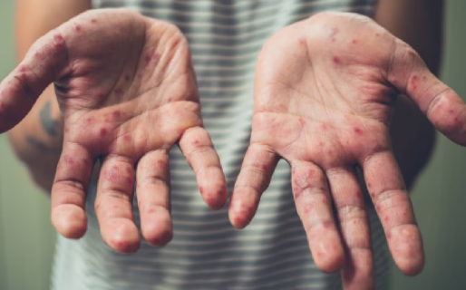 Salud Nación emitió una alerta por sarampión: piden extremar controles y revisar el carnet de vacunación