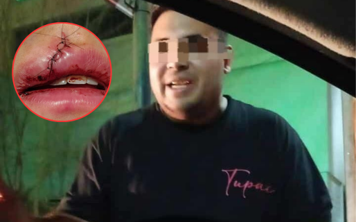 Brutal agresión en un boliche: un hombre de 30 años le desfiguró la cara a un chico de 20