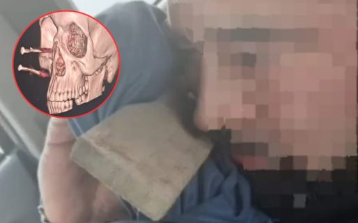 Un comodorense sufrió un brutal accidente y terminó con dos clavos en el rostro