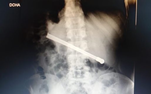 Un preso se tragó una bombilla de mate y tuvieron que operarlo