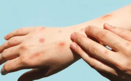 Confirman dos casos de viruela símica en Santa Cruz