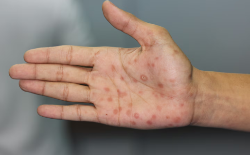 Alerta por sífilis: los casos alcanzan cifras récord en la Argentina y crecen sobre todo entre los jóvenes