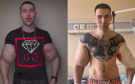 Un influencer se inyectó vaselina en los bíceps para parecerse a “Popeye” y ahora podría perder ambos brazos