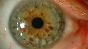 La conmovedora historia de Matías: De una conjuntivitis a un trasplante de córnea